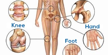 जोड़ों का दर्द: कारण, प्रकार, उपाय, सर्जरी